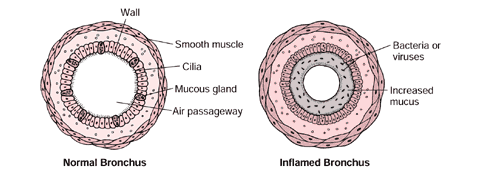 bronchitis