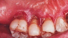 penyakit periodontal berat pada penderita dm.jpg