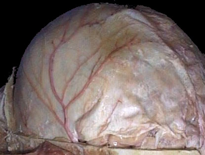 d:\viktoro\neuroscience\trh. head trauma\00. pictures\a. meningea media (macro).jpg