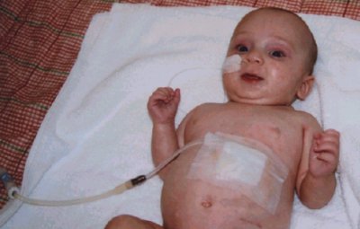 http://www.infodokterku.com/images/stories/tenckhoff%20catheter.jpg