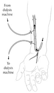 http://www.infodokterku.com/images/stories/fistula%20arteri-vena%20untuk%20hd.gif