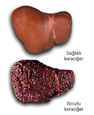 karaciger_hepatit.jpg