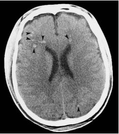 diffuse_axonal_injury