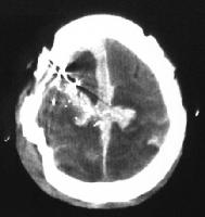 a 65-year-old man experienced a gunshot wound to t