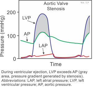 aortic valve stenosis