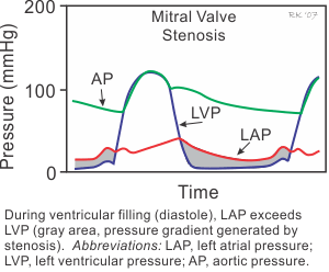mitral valve stenosis