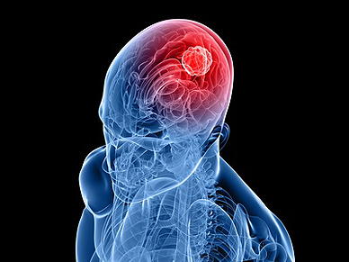 tiefe hirnstimulation
