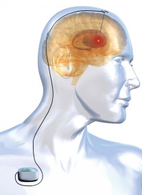 http://www.pharmazeutische-zeitung.de/uploads/pics/med-hirnschrittmacher_28305.jpg
