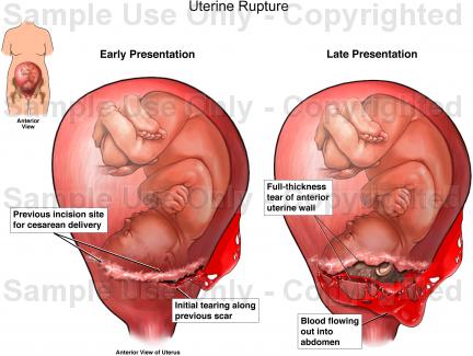 rupture-uterine-13115_3