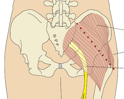 http://nursing.edu.ru/images/content-images/inj5b.jpg