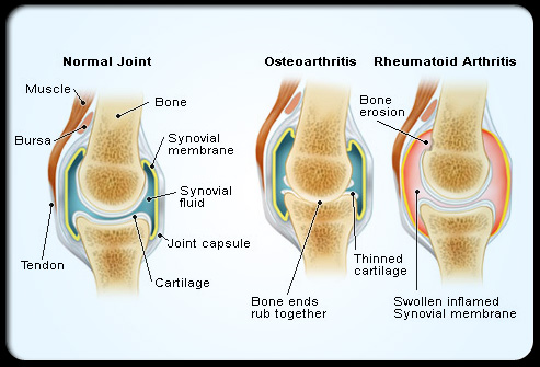 d:\turkane tibb\referat\patan\rheumatoid_arthritis_s4_normal_affected_joints.jpg