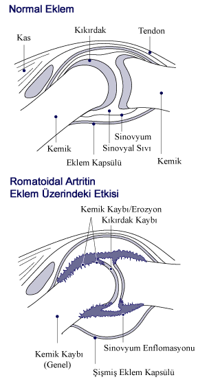 http://upload.wikimedia.org/wikipedia/tr/7/7e/rheumatoid_arthritis_joint.gif