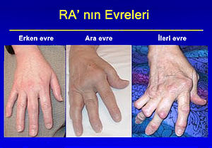 http://upload.wikimedia.org/wikipedia/tr/thumb/3/3a/arthrite_rhumatoide.jpg/300px-arthrite_rhumatoide.jpg