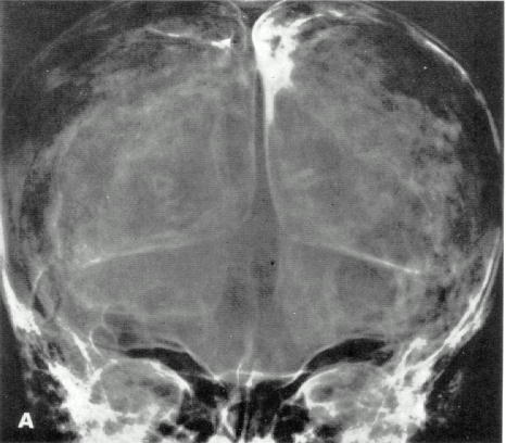 d:\viktoro\neuroscience\trh. head trauma\00. pictures\subhem1 (ro).jpg