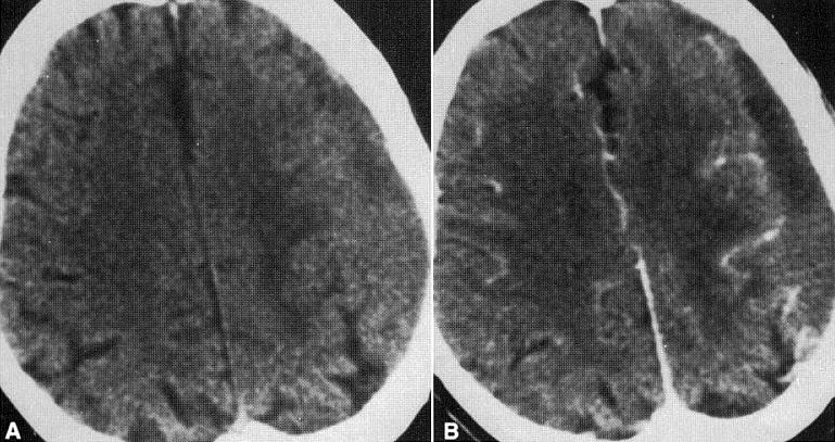 d:\viktoro\neuroscience\trh. head trauma\00. pictures\subacute sdh (ct with and without contrast).jpg
