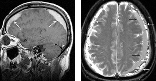 d:\viktoro\neuroscience\trh. head trauma\00. pictures\subhem (mri).jpg