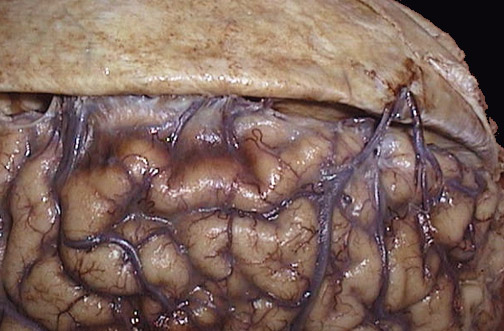 d:\viktoro\neuroscience\trh. head trauma\00. pictures\bridging veins (macro).jpg