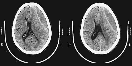 d:\viktoro\neuroscience\trh. head trauma\00. pictures\subdural hematoma (ct).jpg
