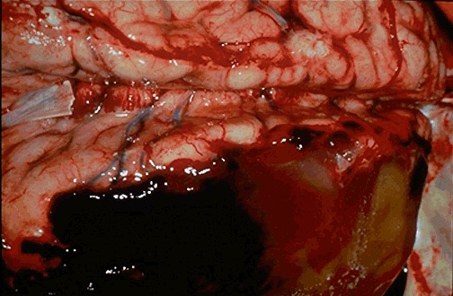 d:\viktoro\neuroscience\trh. head trauma\00. pictures\subdural hematoma (macro).jpg