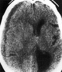 d:\viktoro\neuroscience\trh. head trauma\00. pictures\subacute sdh (ct).jpg