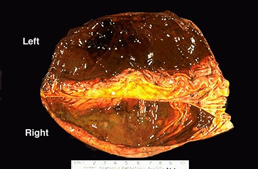 d:\viktoro\neuroscience\trh. head trauma\00. pictures\chronic subdural hematoma (macro).jpg