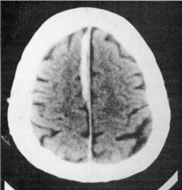 d:\viktoro\neuroscience\trh. head trauma\00. pictures\subhem6 (ct).jpg