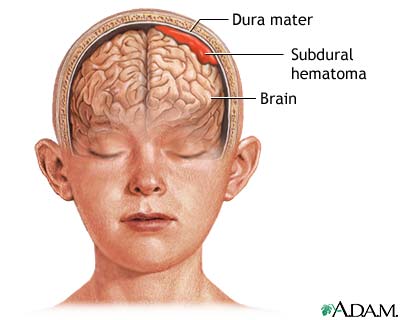 subdural hematoma animation.jpg