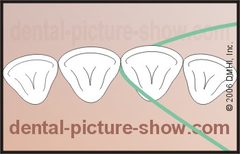 wrap the dental floss up against the side of the tooth.